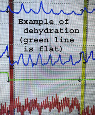 polygraph lie detector test in Los Angeles where examinee is dehydrated